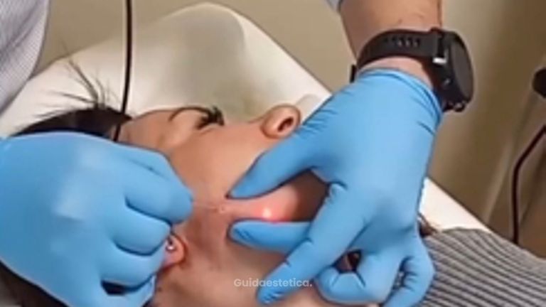 Dr Luciano Perrone Endolift
