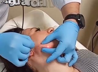 Dr Luciano Perrone Endolift