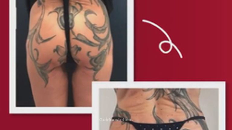 Dott. Massimo Re Prima e dopo di una gluteoplastica