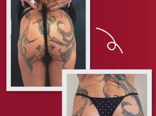 Dott. Massimo Re Prima e dopo di una gluteoplastica