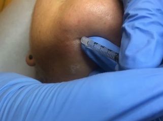 Trattamento pieghe verticali del collo tecnica Dottor basso