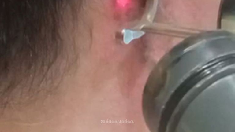 Dott.ssa Cornelia Florea Rimozione tatuaggio con laser: come funziona il trattamento