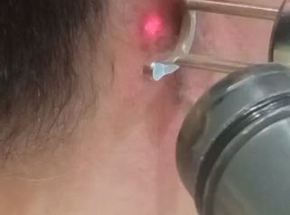 Dott.ssa Cornelia Florea Rimozione tatuaggio con laser: come funziona il trattamento