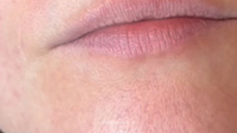 Dott.ssa Sara Carinci Come migliorare labbra poco definite: risultato reale