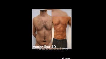 Vaser Lipo - Dott. Hicham Mouallem