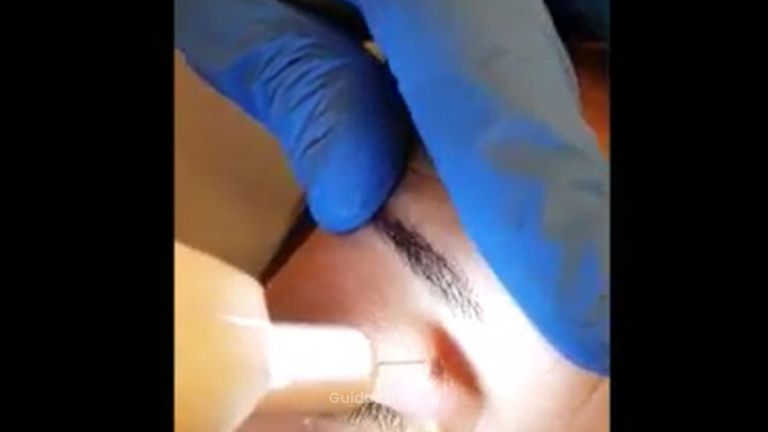 Medestetclinic: Xantelasmi