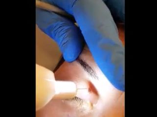 Medestetclinic: Xantelasmi