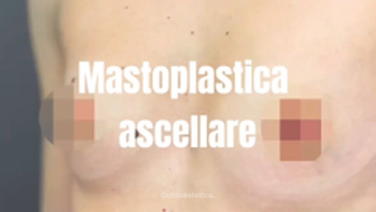 Mastoplastica Additiva Ascellare Endoscopica 1 anno