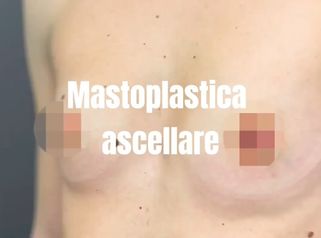 Mastoplastica Additiva Ascellare Endoscopica 1 anno