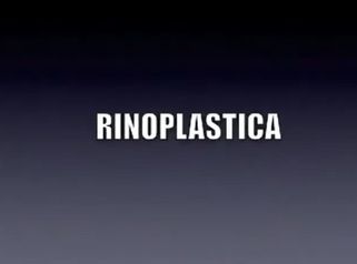 RINOPLASTICA - intervento eseguito dal Dott Massimo Re chirurgo plastico ed estetico.