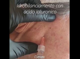 Idrobilanciamento con acido ialuronico - Dott.ssa Carla Enrica Marino