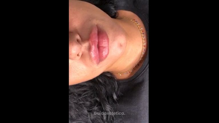 Filler labbra by Dr. Pierluigi Gigliofiorito per Dr.Lips: risultato a fine seduta