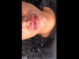 Filler labbra by Dr. Pierluigi Gigliofiorito per Dr.Lips: risultato a fine seduta