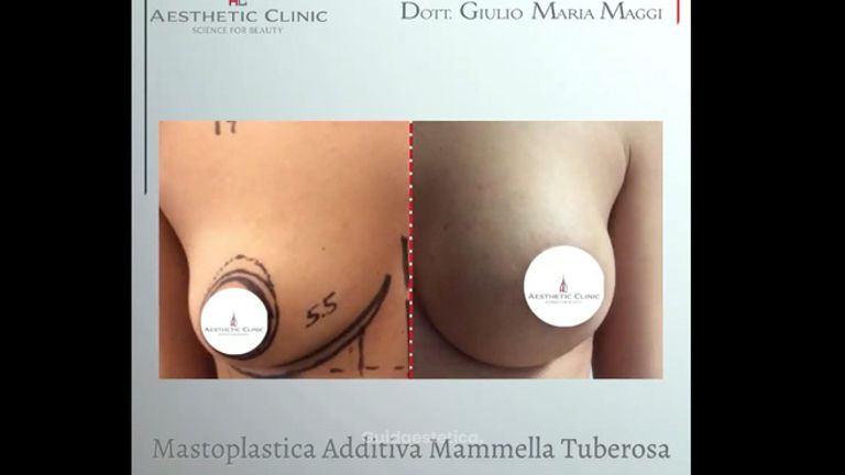 Mastoplastica additiva - Aesthetic Clinic del Dott. Giulio Maria Maggi