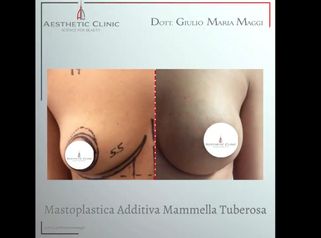 Mastoplastica additiva - Aesthetic Clinic del Dott. Giulio Maria Maggi