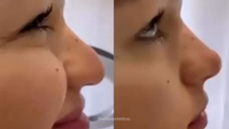 Venini Ventitre Medical Center Rinofiller per punta naso che scende con il sorriso