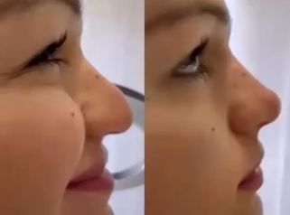 Venini Ventitre Medical Center Rinofiller per punta naso che scende con il sorriso