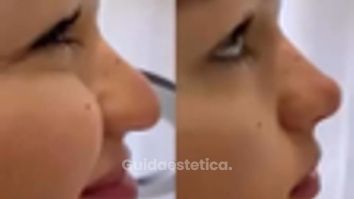 Venini Ventitre Medical Center Rinofiller per punta naso che scende con il sorriso