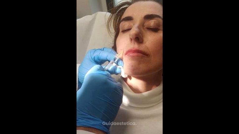 Filler - Cliniche Novagenesis - dott. Alberto Rossi Todde