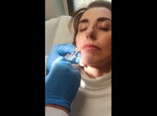 Filler - Cliniche Novagenesis - dott. Alberto Rossi Todde