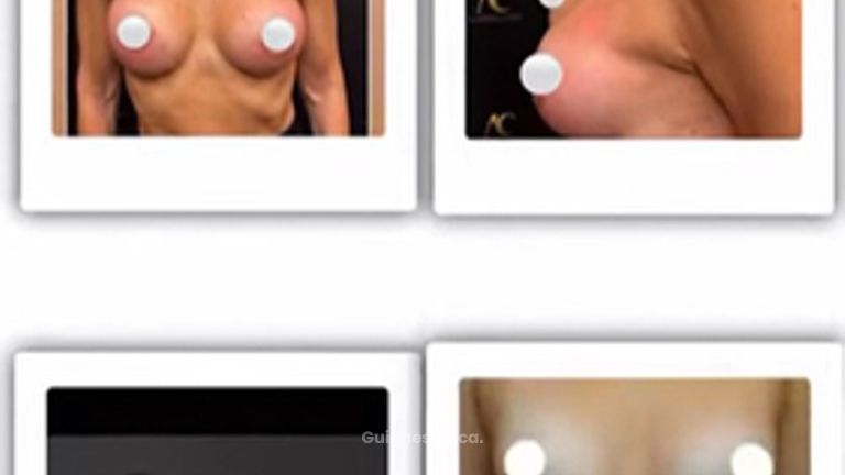 Dottor Alberto Capone Prima e dopo di interventi di chirurgia estetica