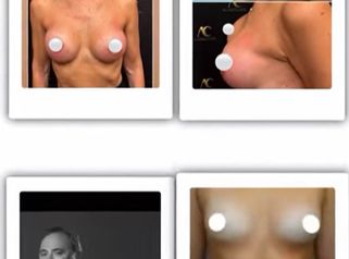 Dottor Alberto Capone Prima e dopo di interventi di chirurgia estetica