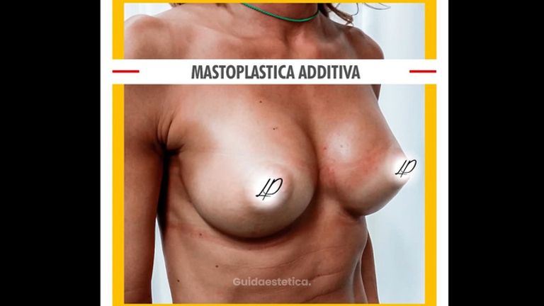 Mastoplastica additiva
