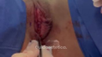 Labioplastica - Dott. Domenico Mileto