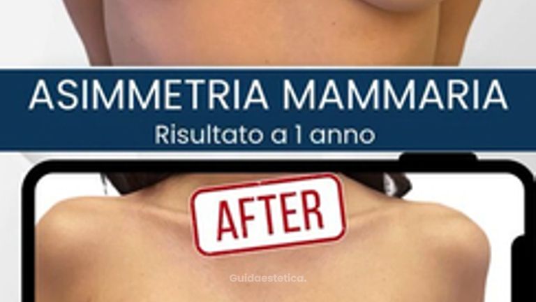 Dott. Alfredo Altieri Correzione asimmetria mammaria con round block