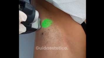 Depilazione laser - Tuamedica