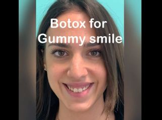 Botox per Gummi Smile