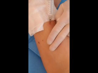 Liposuzione - Tuamedica