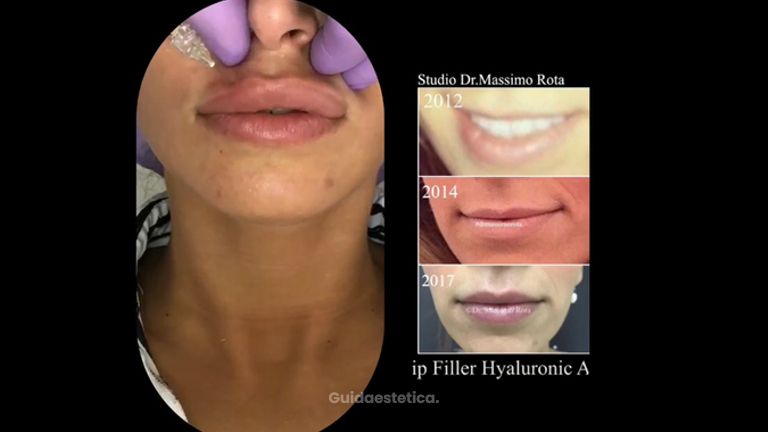 Dr.Massimo Rota: il Filler Labbra Acido Ialuronico  