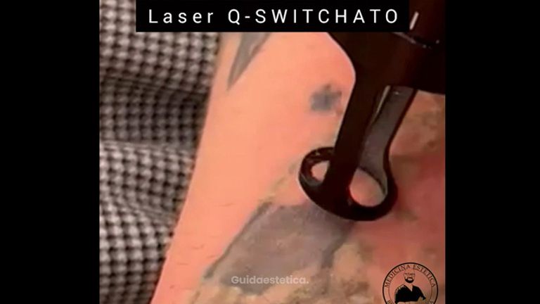 Rimozione tatuaggi - Dott. Luca Lungo Vaschetto