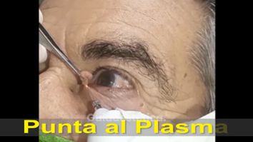 Rimozione Verruche con punta al plasma