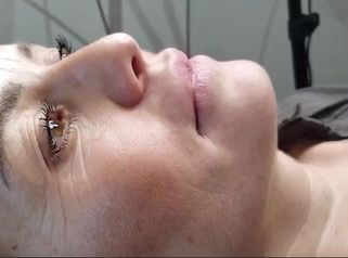 Filler labbra - Poliambulatorio Med360