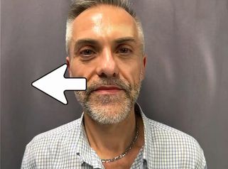 Prof. Dott. Massimiliano Giuliano Trattamento di medicina rigenerativa