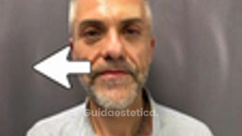 Prof. Dott. Massimiliano Giuliano Trattamento di medicina rigenerativa