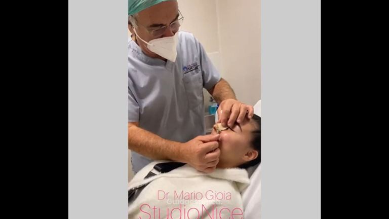 Rinoplastica - Dr. Gioia Mario
