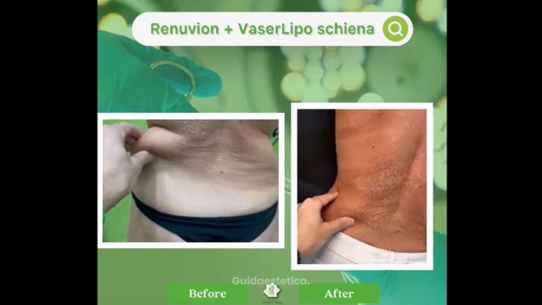 Liposuzione - Dott. Umberto Tozzi - Clinique Visage
