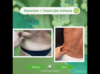 Liposuzione - Dott. Umberto Tozzi - Clinique Visage
