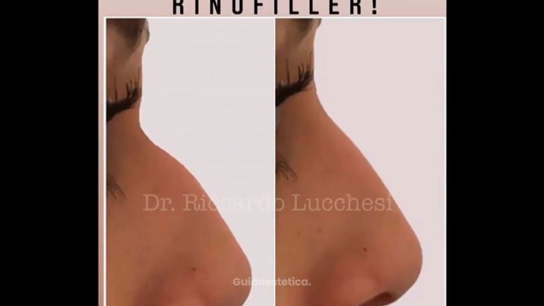 Rinofiller - Dott. Riccardo Lucchesi