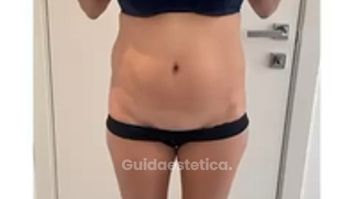 Dott.ssa Maria Stella Tarico Vaser lipo: rimodellare addome, fianchi e schiena