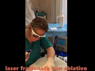 Laser frazionato no ablativo