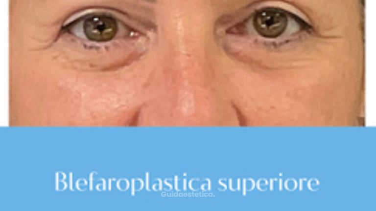 Blefaroplastica Superiore - Canova Institute