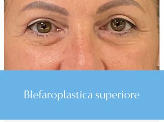 Blefaroplastica Superiore - Canova Institute