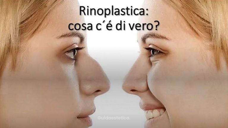 Rinoplastica: ecco tutte le risposte alle vostre domande! || Dr Montemurro - Chirurgo Plastico