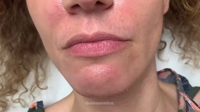 Filler labbra - Studio medico Monica De Stefani