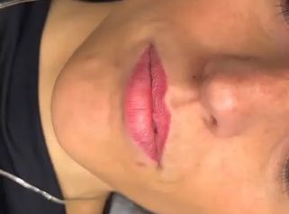 PPM Medical Risultato filler labbra: aumento volume e definizione naturale