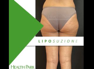 Liposuzione - Health Park- Andrea Grimaldi Medical Care